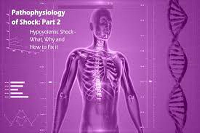 Hypovolemic shock