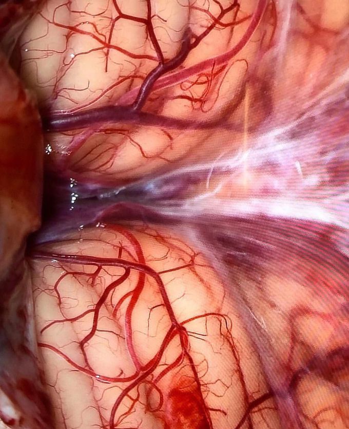 An eye catching view of the cerebellum. 