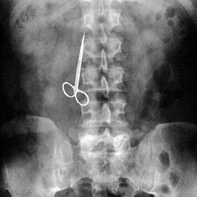Hey you surgeon, you've forgot a scissor inside my body