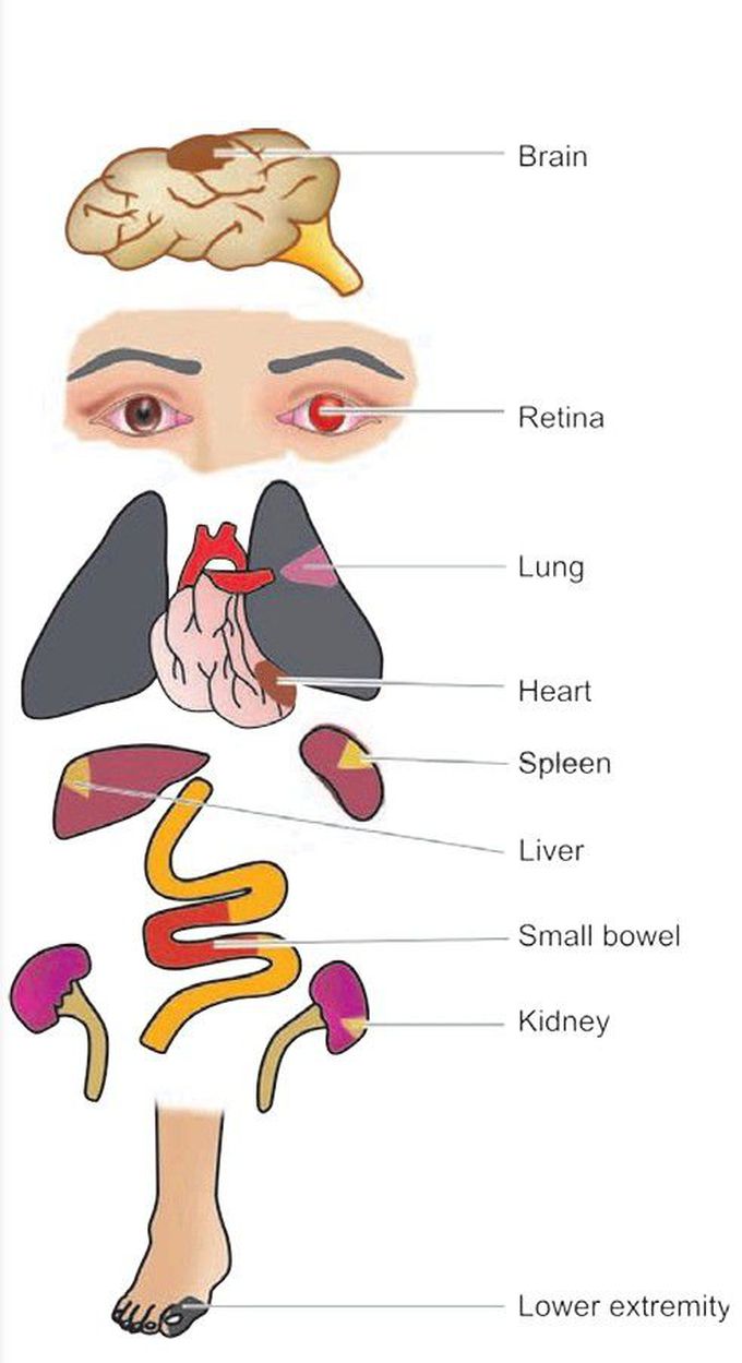 Infarct location