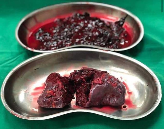 Spleen trauma