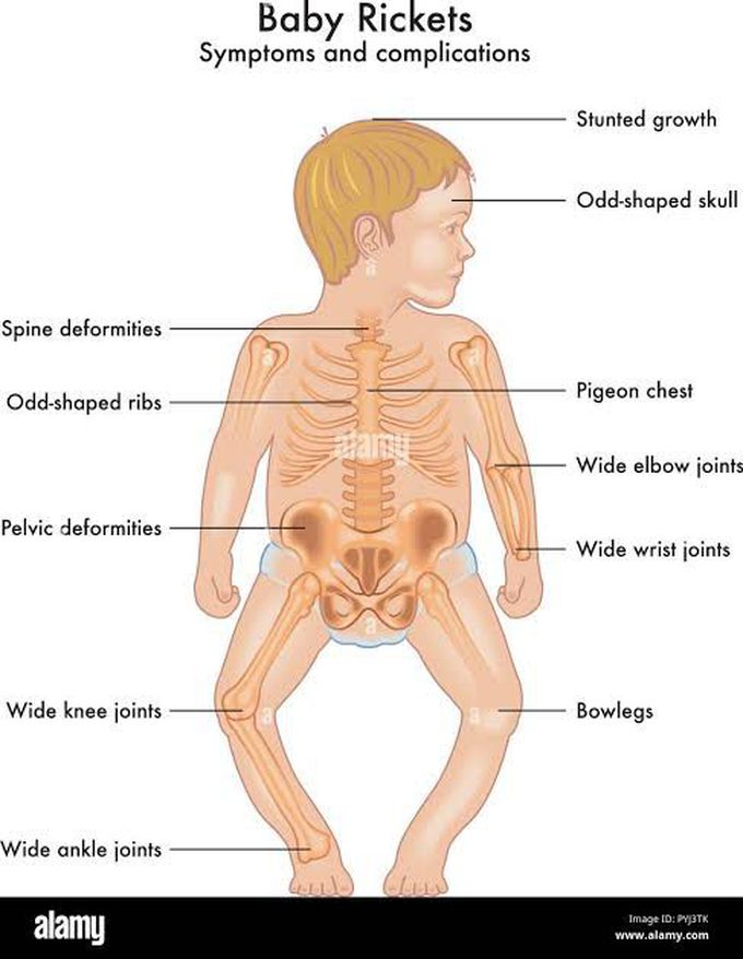 Rickets clinical features