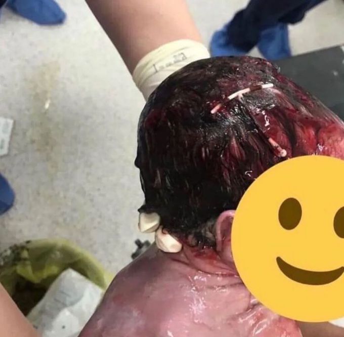 IUD device in baby's head