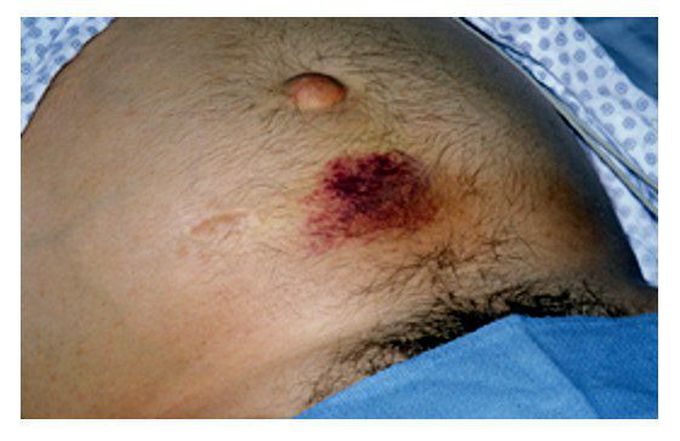 Causes of Cullen’s Sign