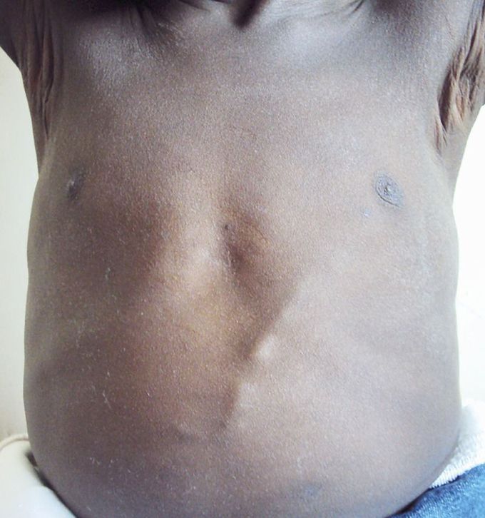 Mondor's Disease