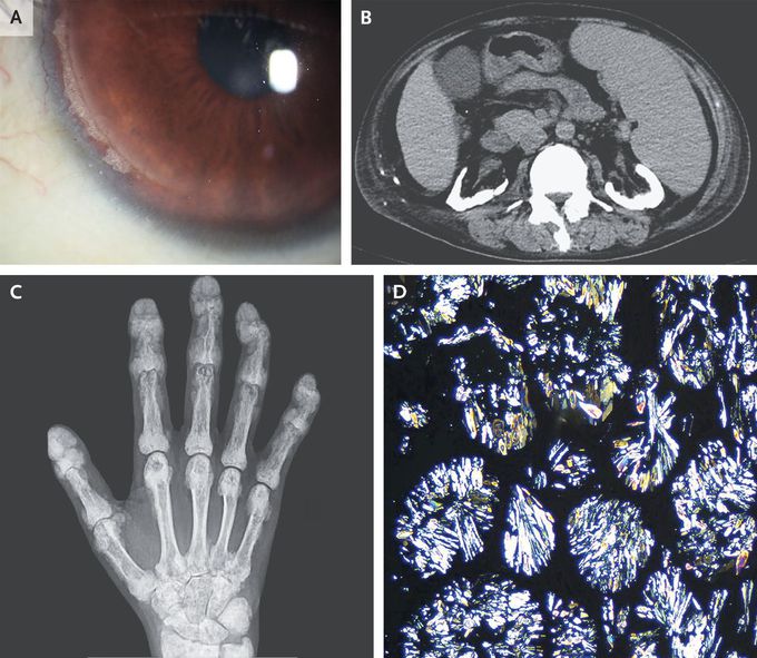 Primary Hyperoxaluria