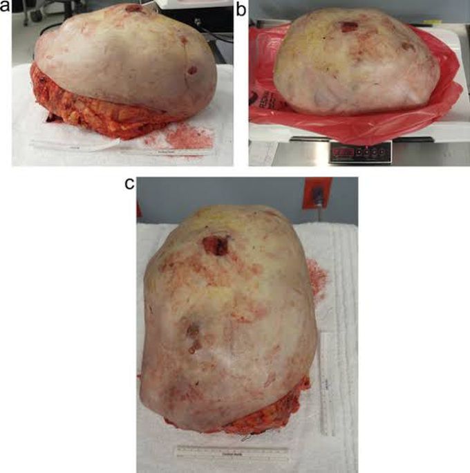 Aggressive tumor of breast : Phyllodes tumor