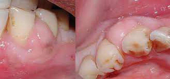 periodontal abscess