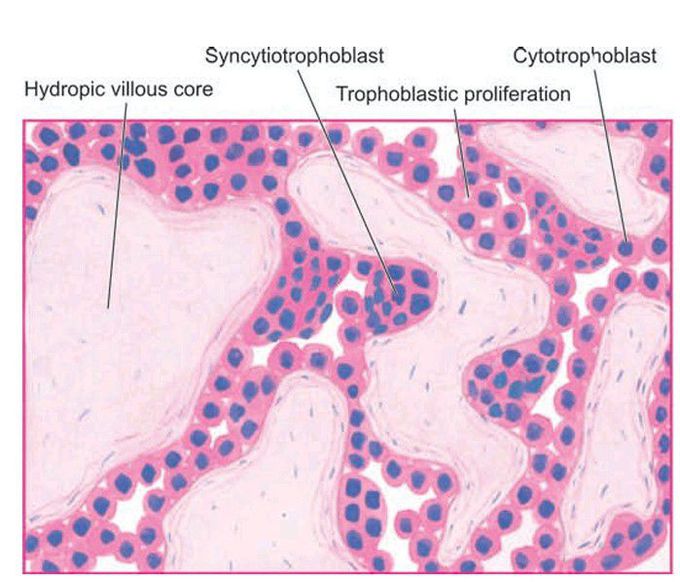 Hydatidiform mole