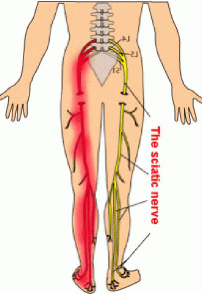 Sciatica