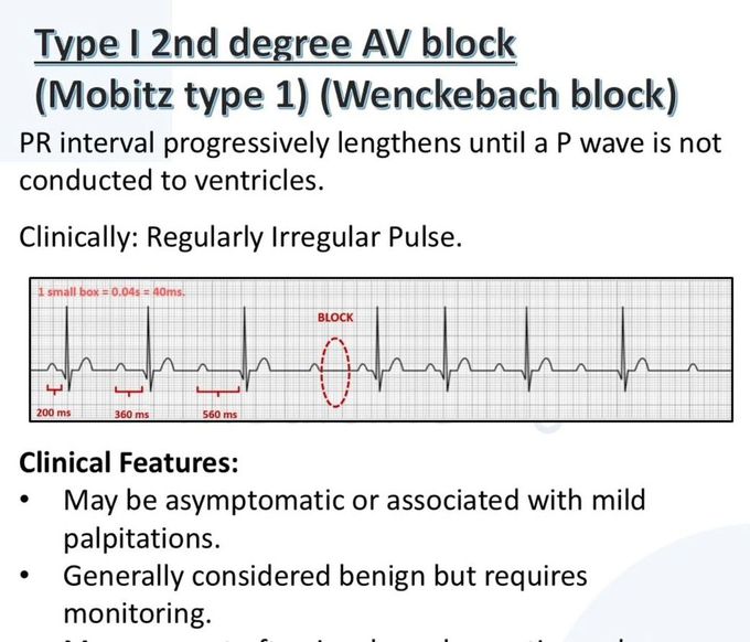 Heart Block V
