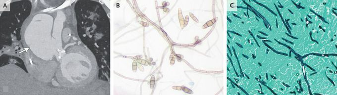 Curvularia alcornii Infection