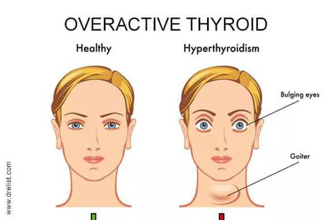 Treatment of hyperthyroidism