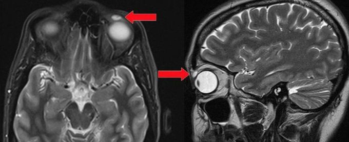 A Woman Had a Contact Lens Stuck in Her Eyelid For 28 Years. She Didn't Notice It