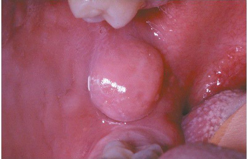Epulis Granulomatosa PYOGENIC GRANULOMA. Nonneoplastic Unrelated To