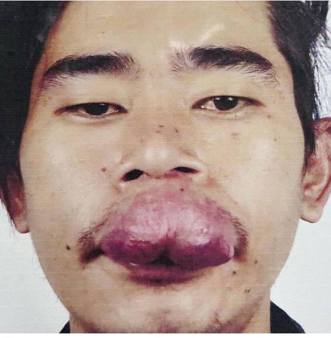 Large Upper Lip Hemangioma