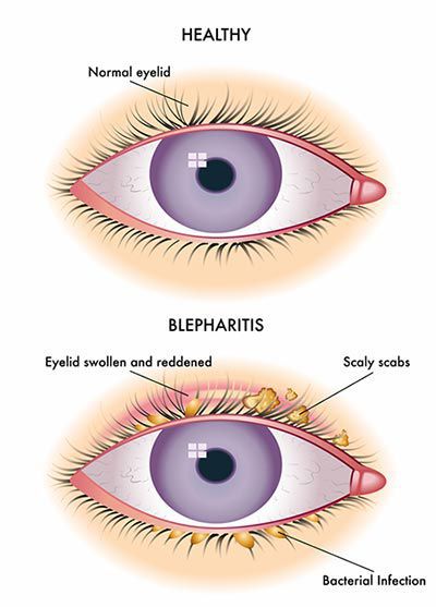 Blepharitis - Medizzy