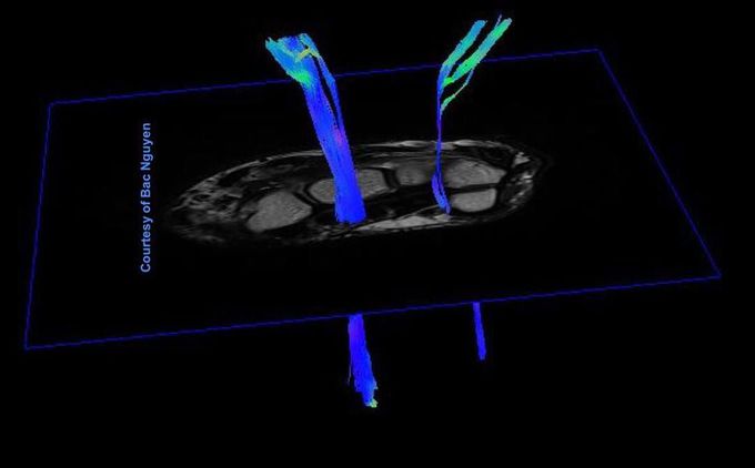 Diffusion Tensor Imaging (DTI) of the wrist