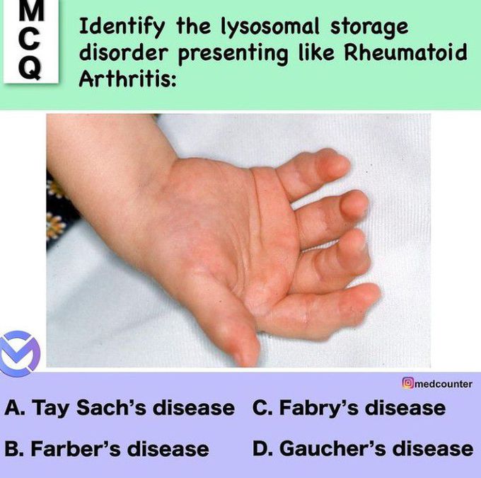 LSD with same presentation as rheumatoid arthritis