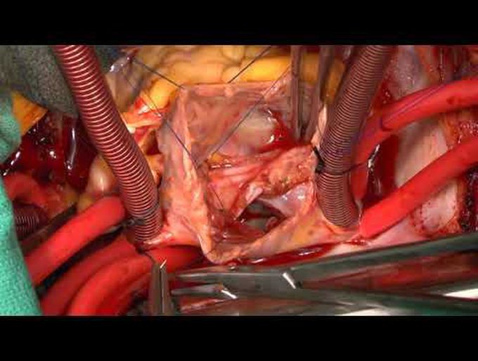 Open Surgical Repair for the Removal of an Atrial Septal Amplatzer™ Device Eroding the Aortic Root