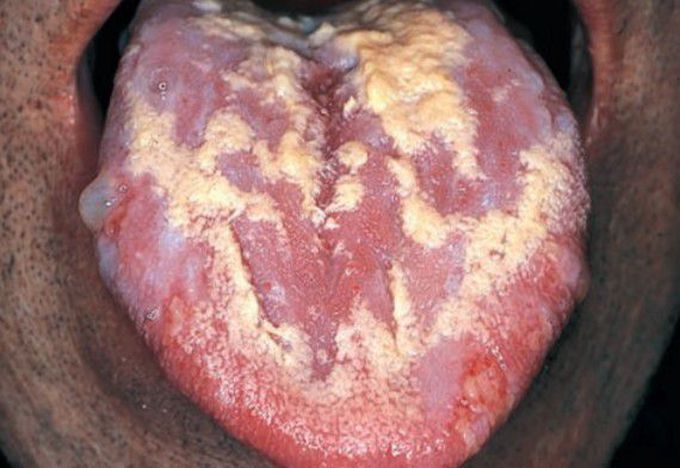 Pemphigus bulla and ulcers