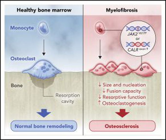 What causes myelofibrosis?