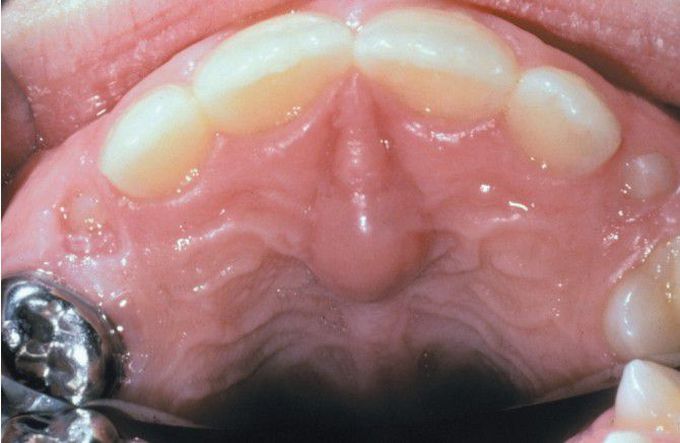 Cyst of incisive papilla