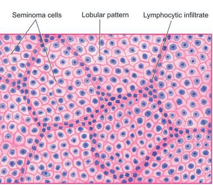 Seminoma testis