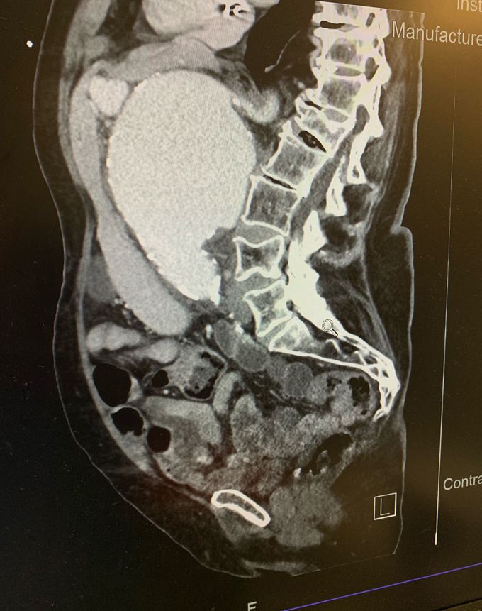 84 y/o patient presented to the ED c/o back pain and mild epigastric pain. CT abdomen revealed a 9.8 cm AAA.