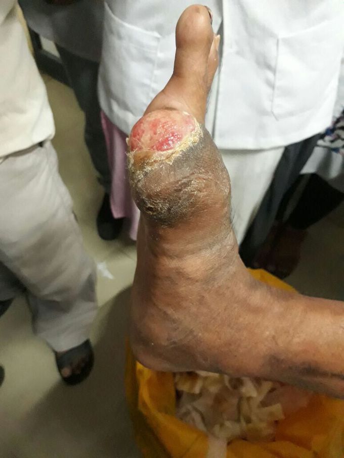 Great toe amputation