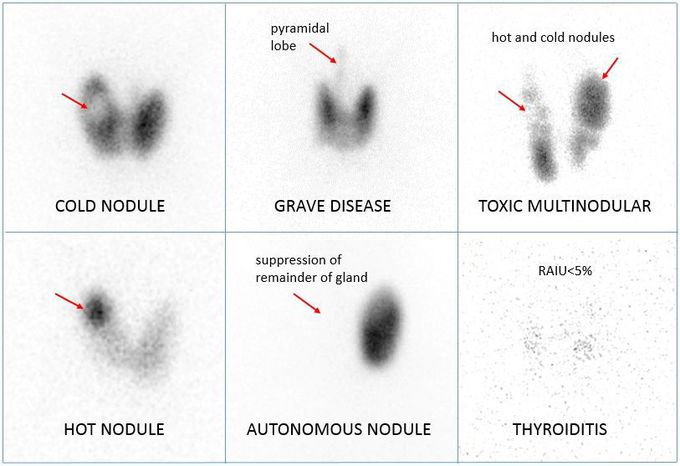 Thyroid Isotope Scanning