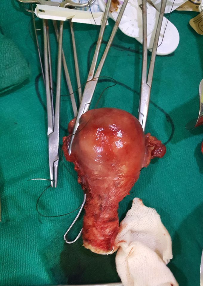 Bulky uterus with Adenomyosis.