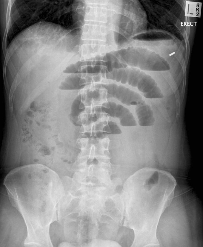 Intestinal obstruction