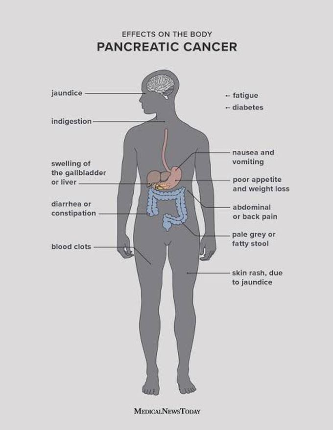Symptoms of pancreatic tumor