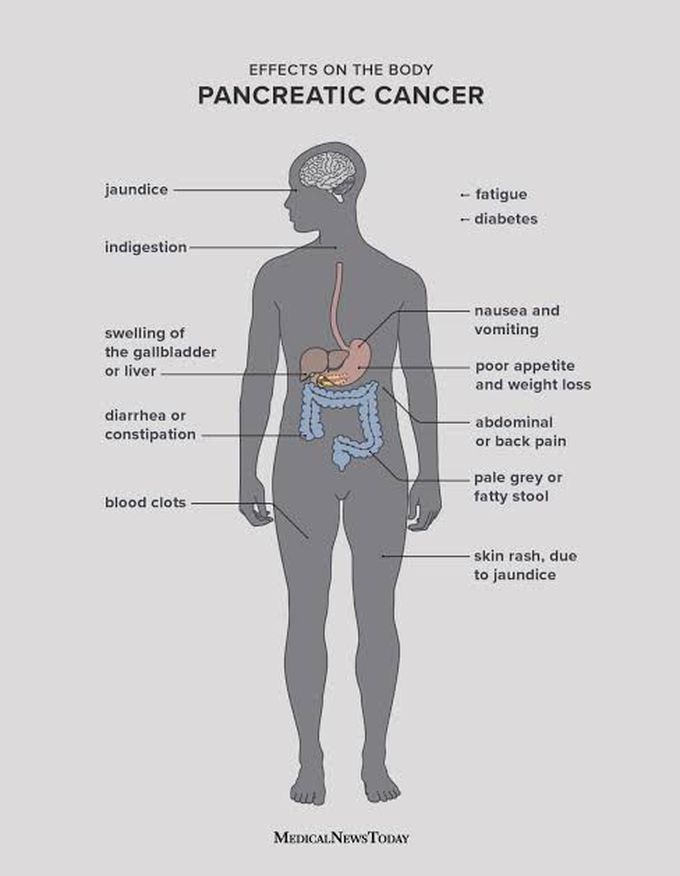 Symptoms Of Pancreatic Tumor Medizzy 8124