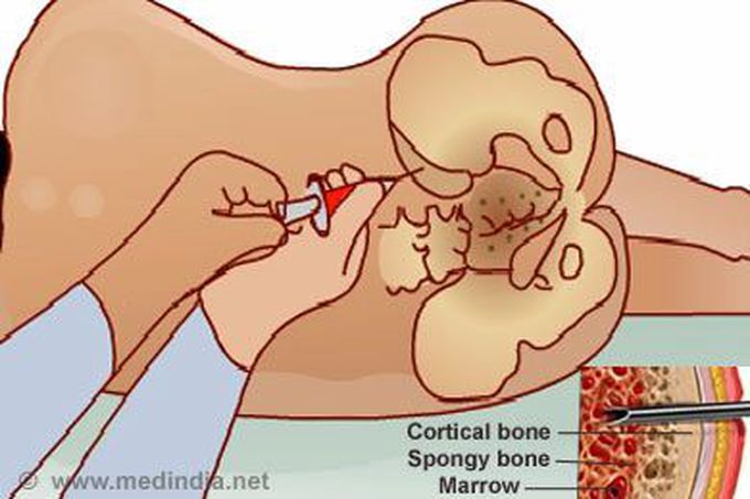 Bone marrow  collection