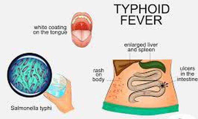 Treatment for typhoid