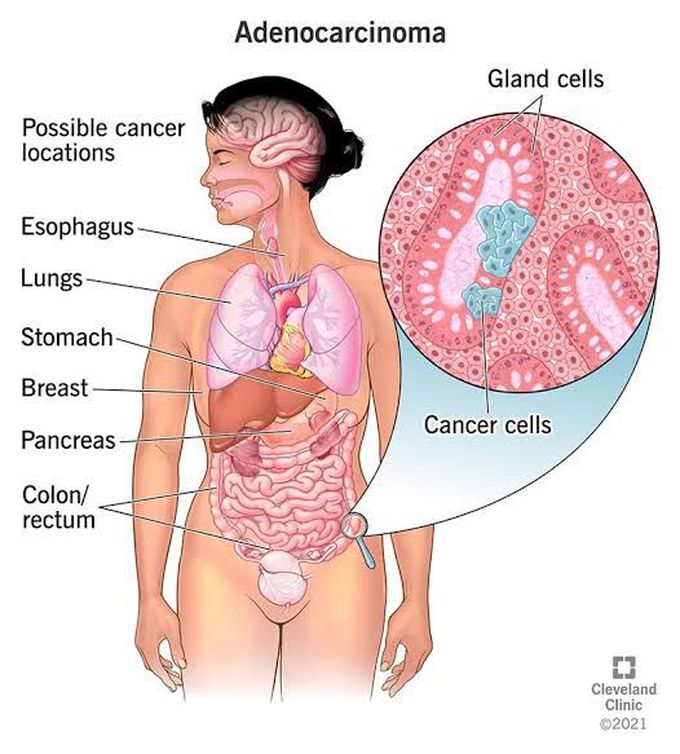 Adenocarcinoma
