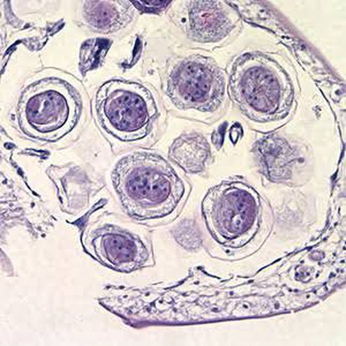 Hymenolepiasis