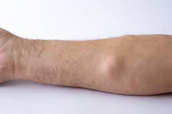 Lipoma