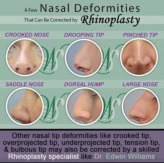 Nasal deformities (Rhinoplasty )