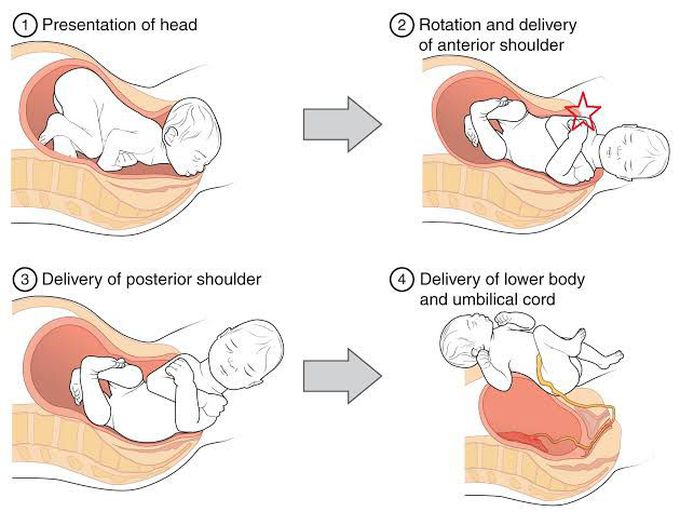 Shoulder dystocia