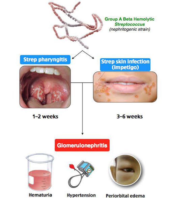Post streptococcal glomerulonephritis Symptoms