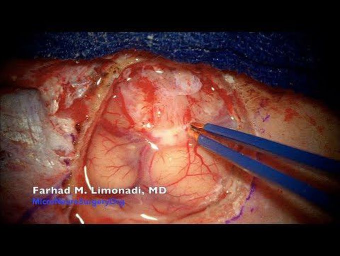 Left frontal metastatic brain tumor: Surgical resection using sodium fluorescein microscopy