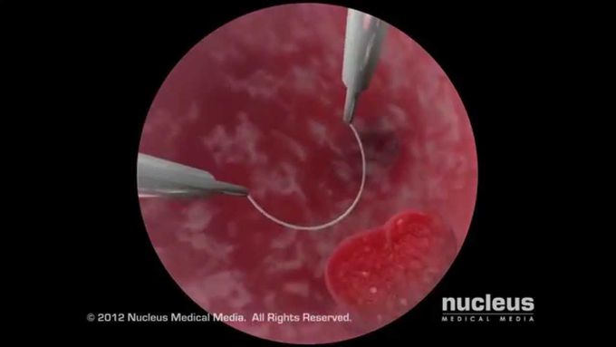 Hysteroscopy