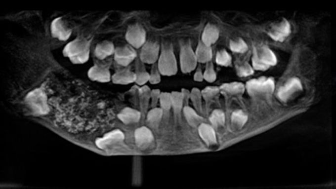 Boy has surgery to remove 526 teeth 'reminiscent of pearls in an oyster'