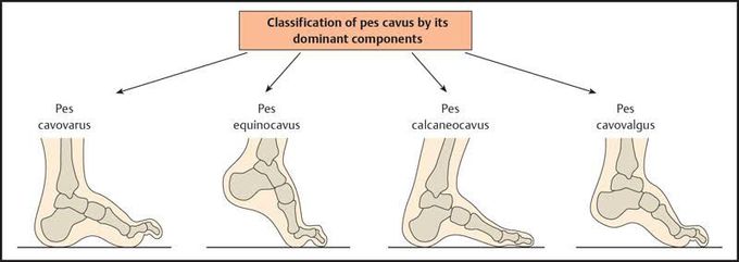 Classification of Pes cavus