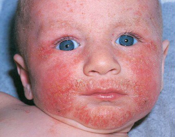 ATOPIC DERMATITIS