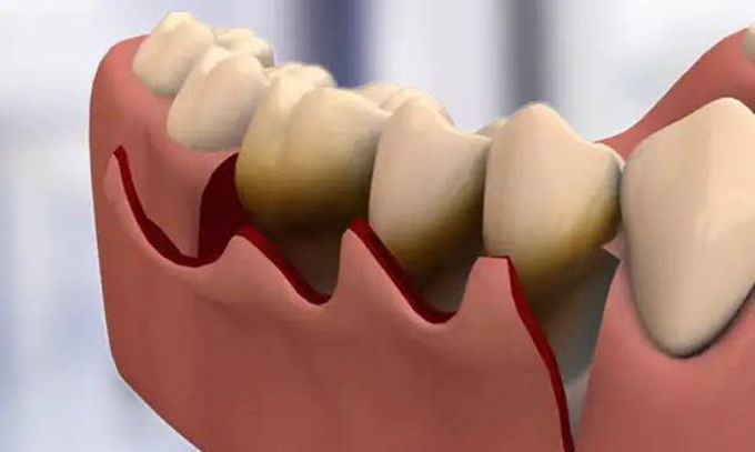 Indications of flap surgery