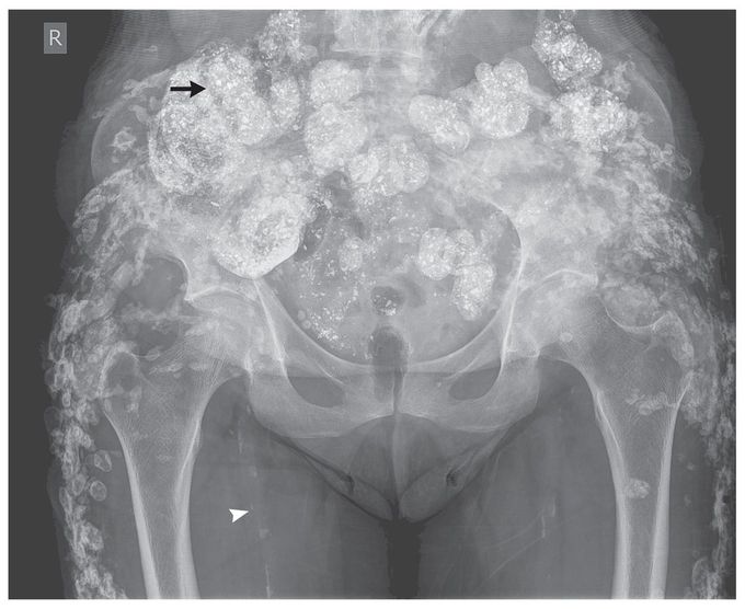 Metastatic Calcification and Long-Term Hemodialysis
